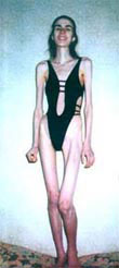 Vera Gapchuk Before Herbalife